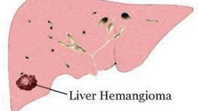 Photo of Liver Hemangioma