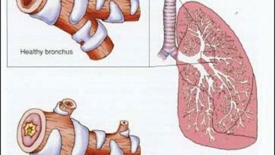 Photo of Bronchitis in Children