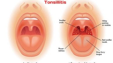 Photo of Adenotonsilitis in Children